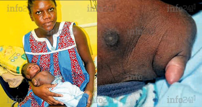 Une jeune gabonaise de 19 ans donne naissance à un bébé sans bras à Lambaréné