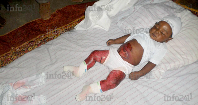 Un nourrisson brulé au 3e degré, décède de ses blessures à Ntoum