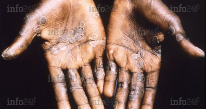 Virus : L’OMS recense déjà 1 400 cas de variole du singe dans 7 pays africains