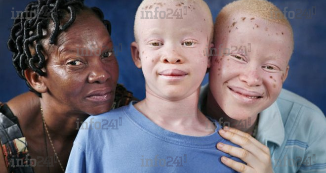 Journée internationale : Sacri International dénonce les crimes rituels contre les albinos