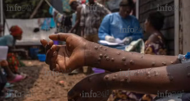 Mpox : Près de 2 000 décès recensés en Afrique depuis 2024 malgré une décrue des cas