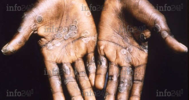 Virus : L’OMS recense déjà 1 400 cas de variole du singe dans 7 pays africains