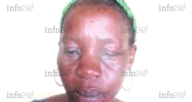 Oyem : Battue par son compagnon violent, une gabonaise perd l’usage de son œil gauche